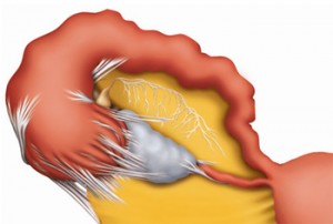 Resolving Hydrosalpinx 