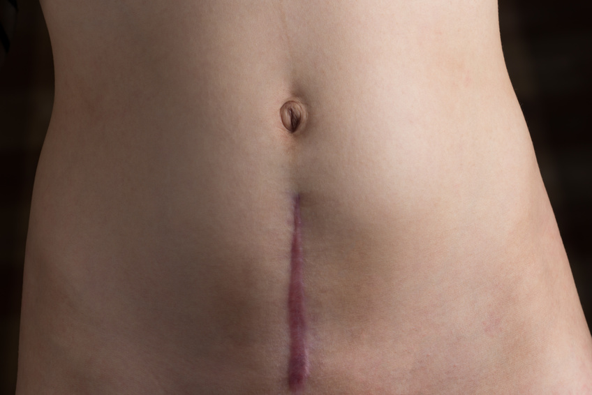 How to Tell if You Have Adhesions After C-Section ( C-Section Scar