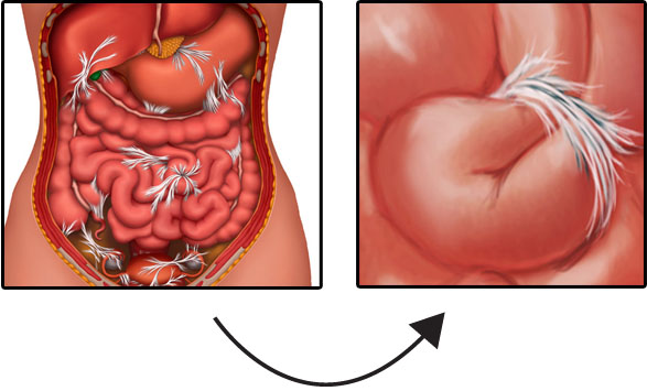 How to prevent small bowel obstruction